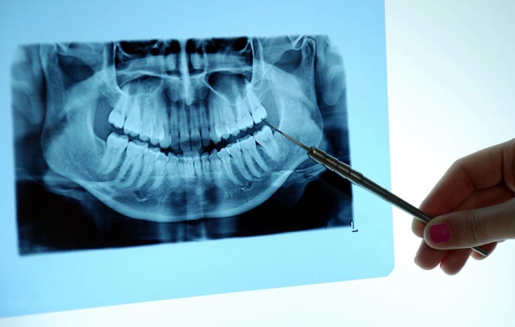 Wisdom Teeth and Sinuses