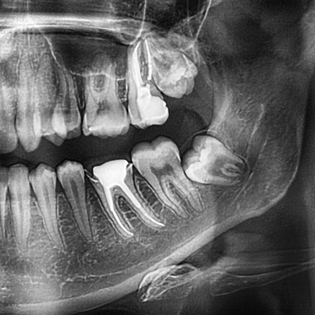 wisdom-teeth-preparation-santa-clarita-advanced-dentistry