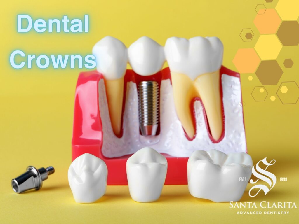Santa Clarita Dentist - Dental Crowns - Restorative Dentistry