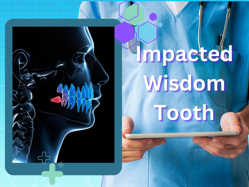 Santa Clarita Dentist - Impacted Wisdom Tooth - Restorative Dentistry.