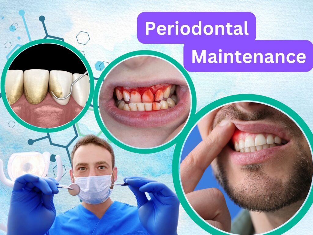 Preventative dentistry - Periodontal Maintenance - Santa Clarita dentist