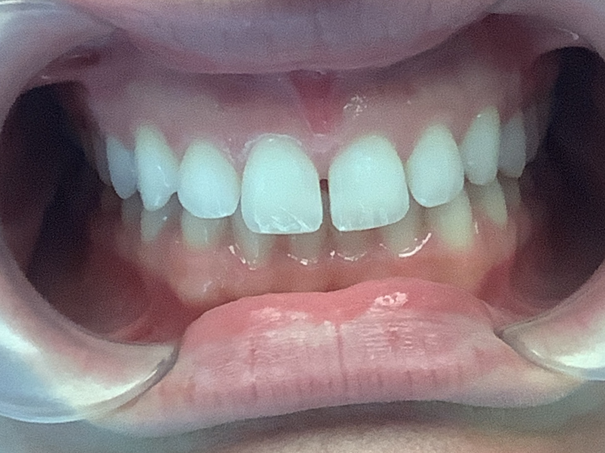 Invisalign before treatment