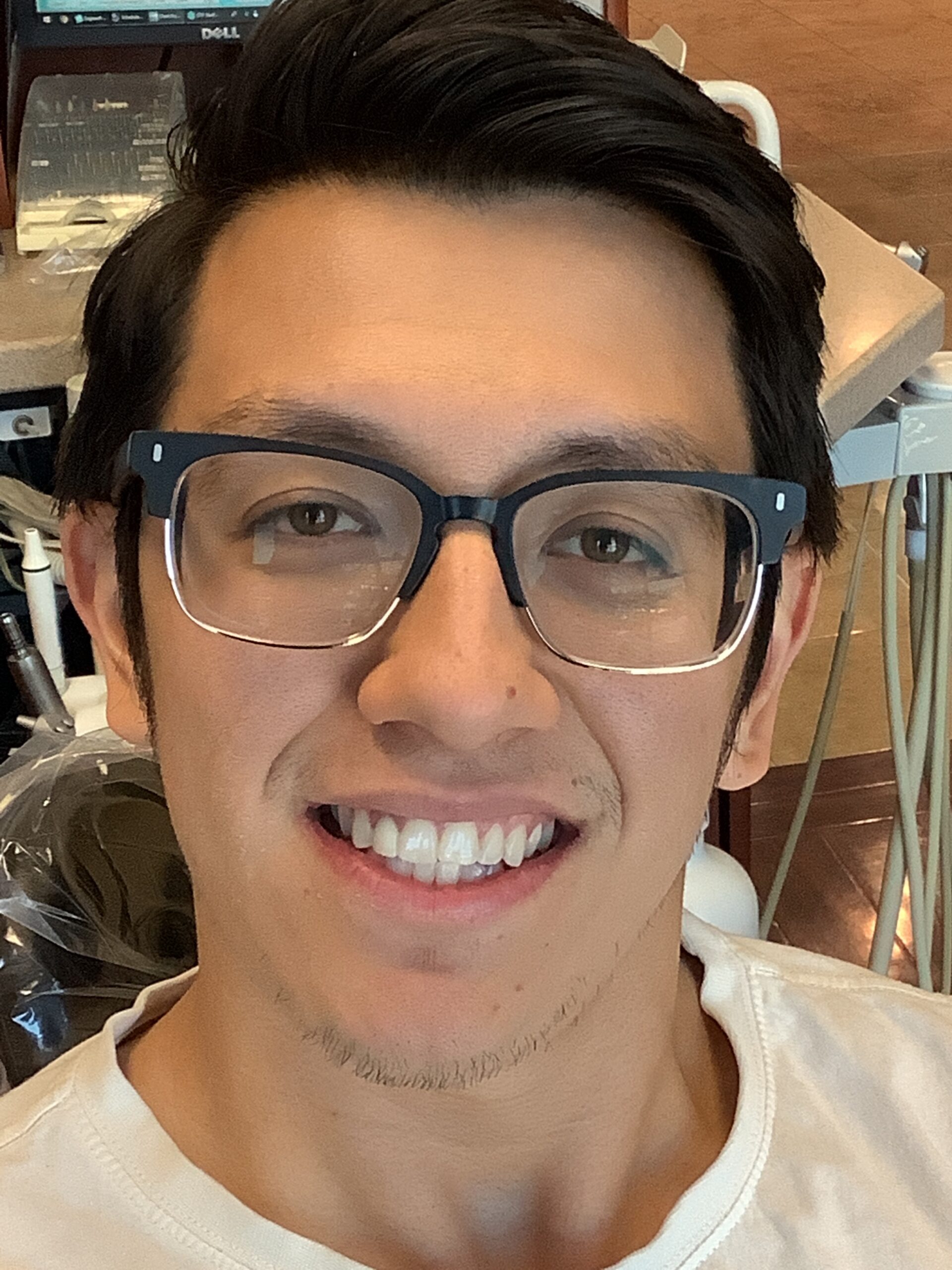 Invisalign before treatment