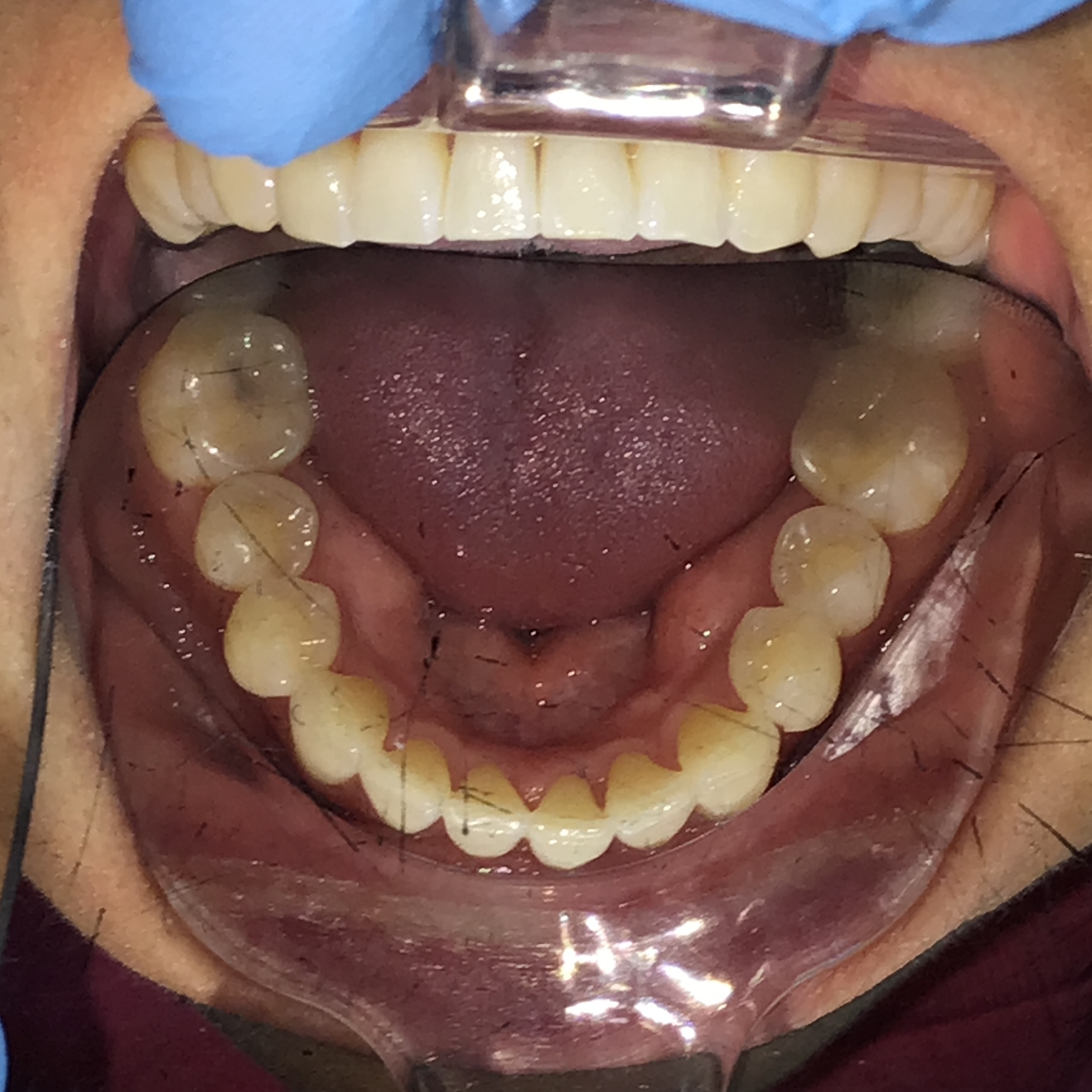 Dental Bonding before treatment
