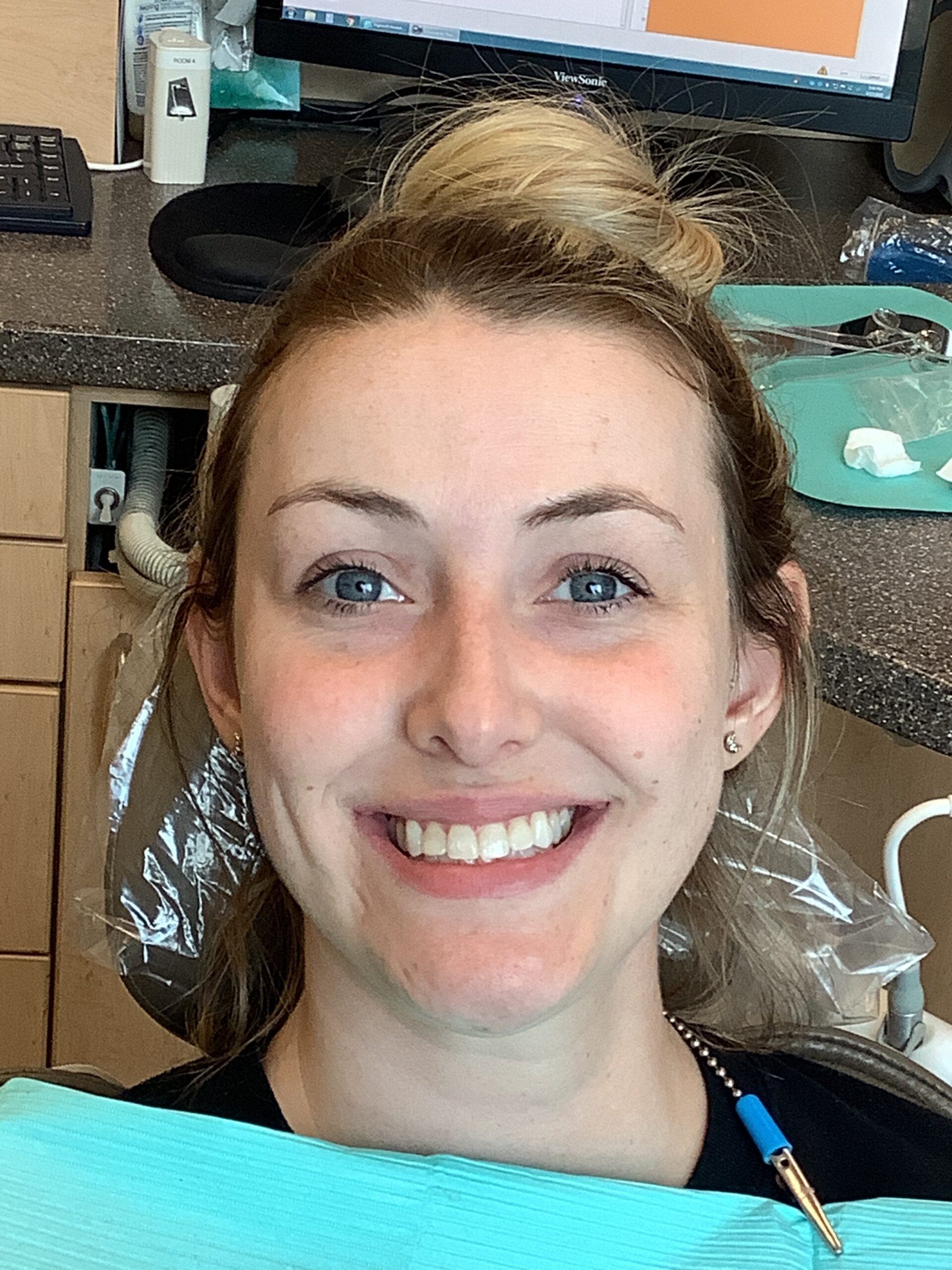 Dental Bonding before treatment