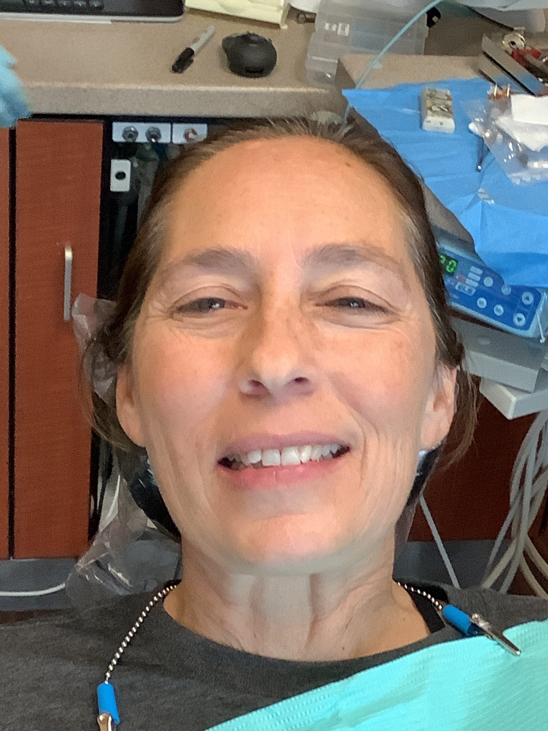 Gum Contouring & Veneers before treatment