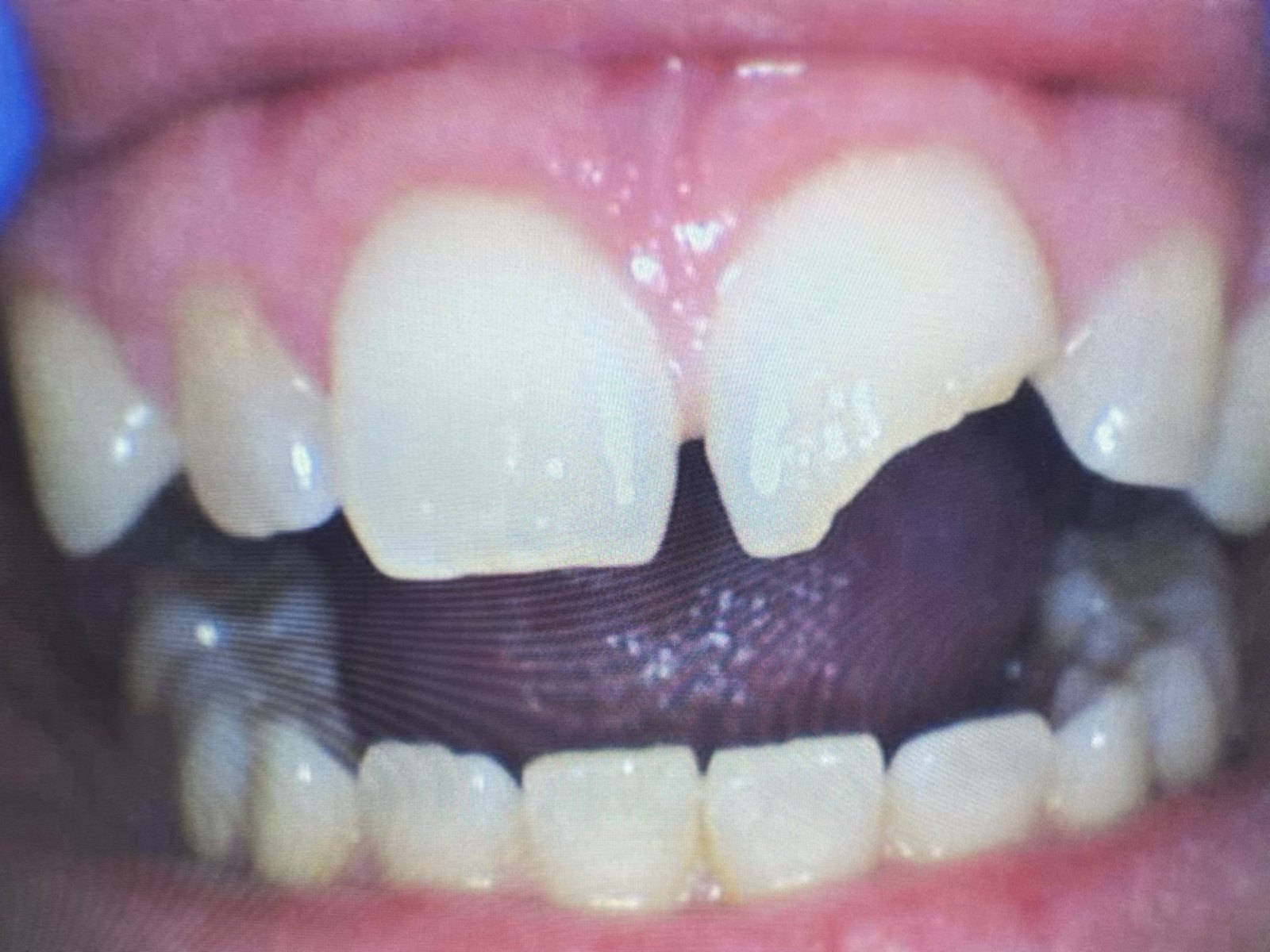 Chipped front tooth before repair
